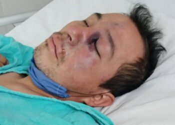 REPORTAN EN EDOMEX PRIMER CASO DE HONGO NEGRO, INFECCIÓN LIGADA AL COVID