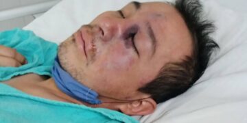 REPORTAN EN EDOMEX PRIMER CASO DE HONGO NEGRO, INFECCIÓN LIGADA AL COVID